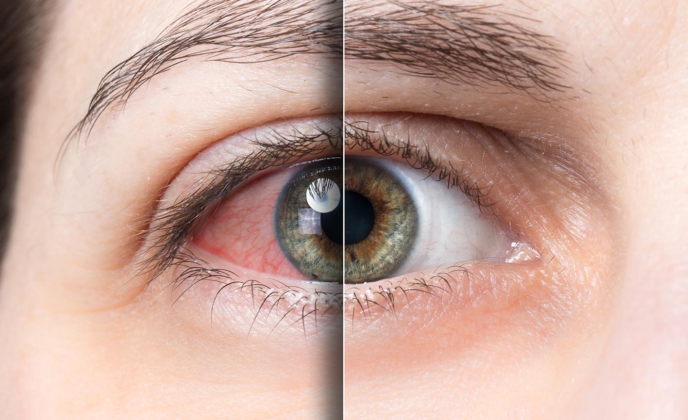 glaucoma-treatment-in-delhi